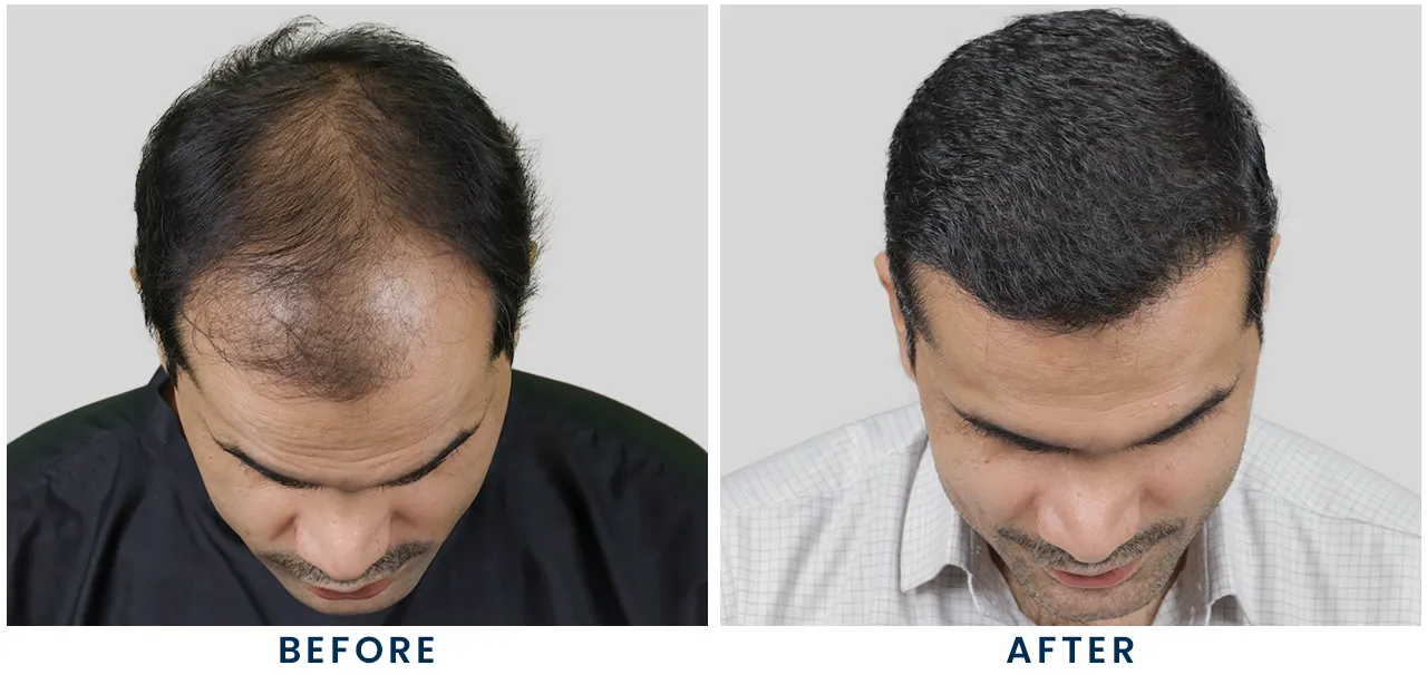 Hair Transplant in Pune