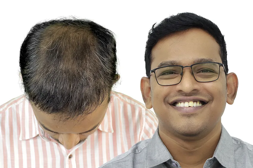 Hair Loss